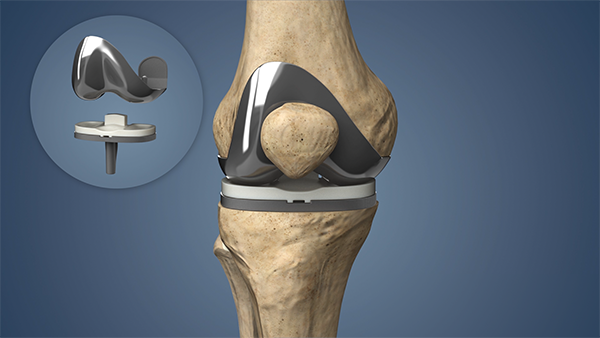 knee Replacement